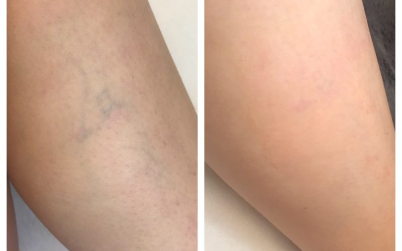 Laser Vein Removal Results