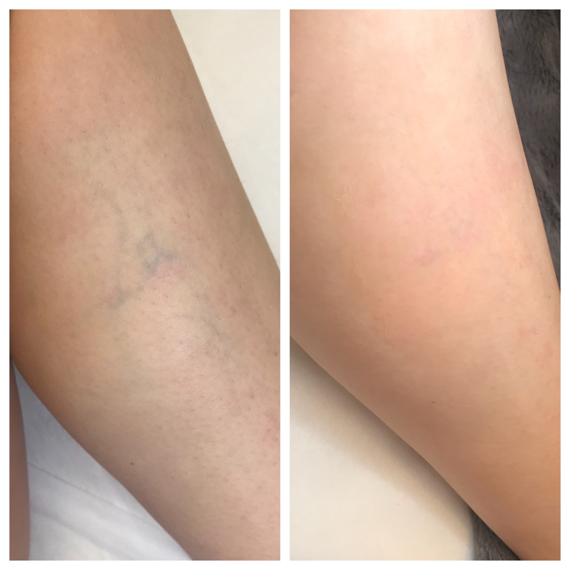 I Got a Laser Treatment for My Spider Veins and this is What Happened