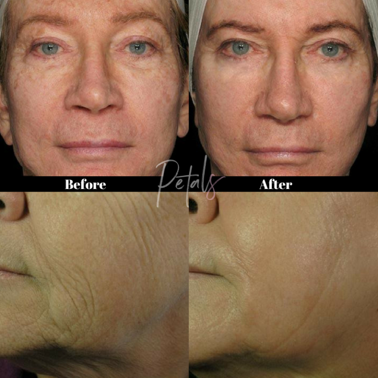 Before and After Results - Icon Laser Treatment - Petals Laser Lounge